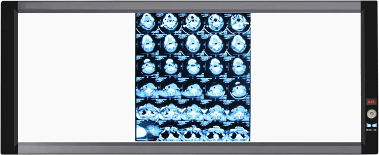 High quality Triple LED x ray film viewing box medical negatoscope