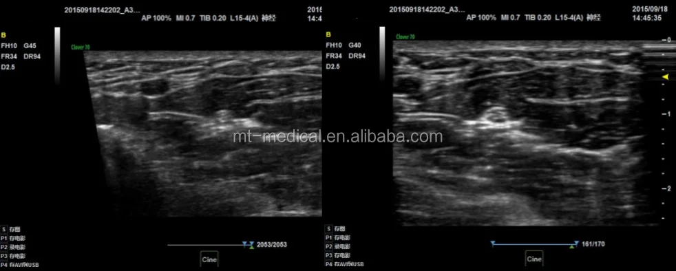 Portable Ultrasonic Diagnostic Devices Type Ultrasound Machine For Pregnancy