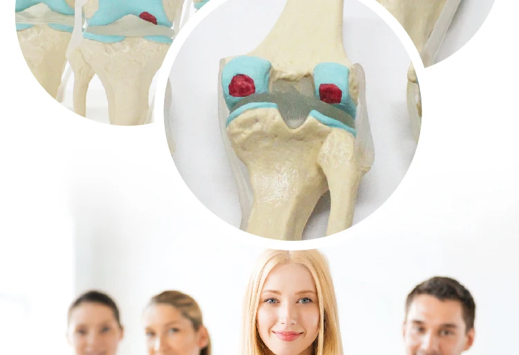 4 Stage Osteoarthritis Knee Model - Educational Tool
