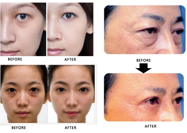 intelligent bonni eye care system treatment of eye bags and dark circle problems