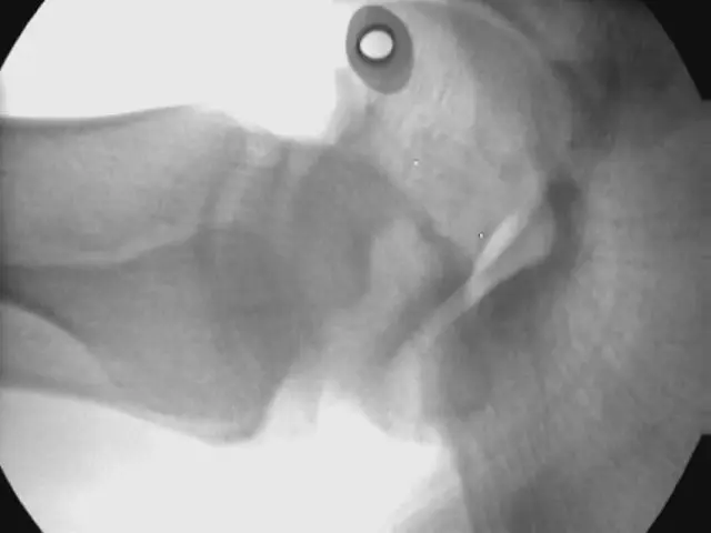 LCD Low-Intensity Portable X-Ray Imaging Scope