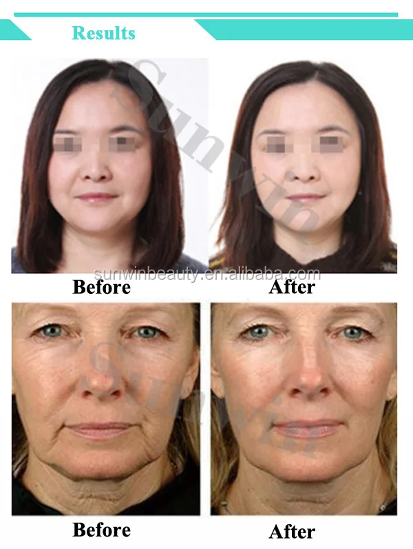 Hot selling portable Hifu Face and Body Machine, Wrinkle Removal mini Hifu lifting with 10000 shots