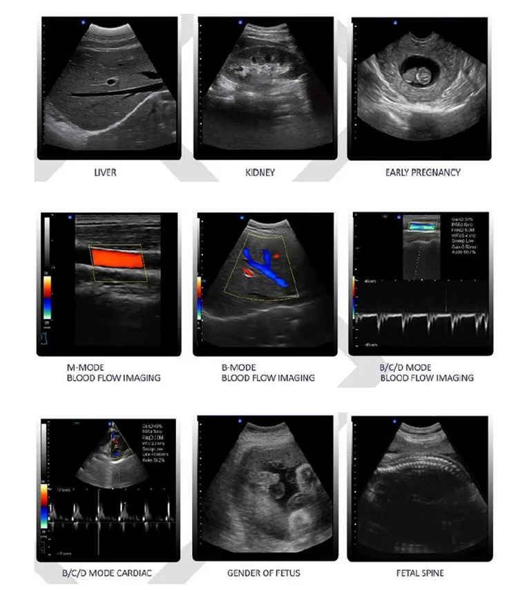 Portable medical equipment mobile computer ultrasound machine with all kinds of probe in hosital