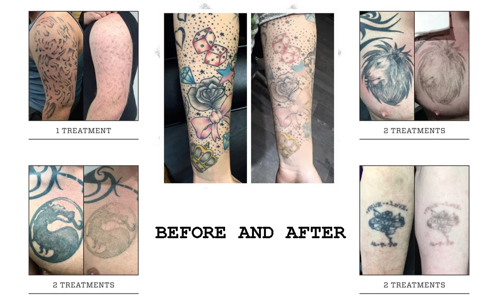 tattoo removal.jpg