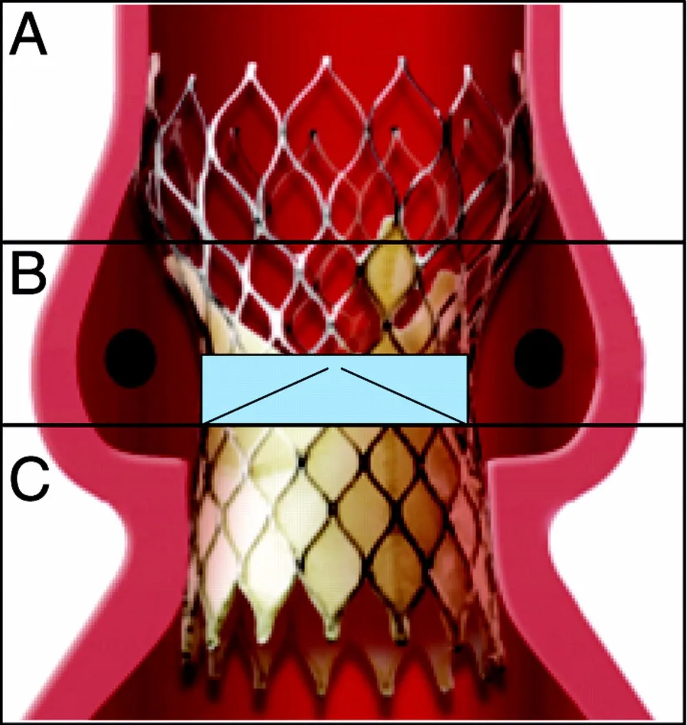 Shape Memory Alloy Nitinol Implanted Flat Wire Af Above 15 Degree