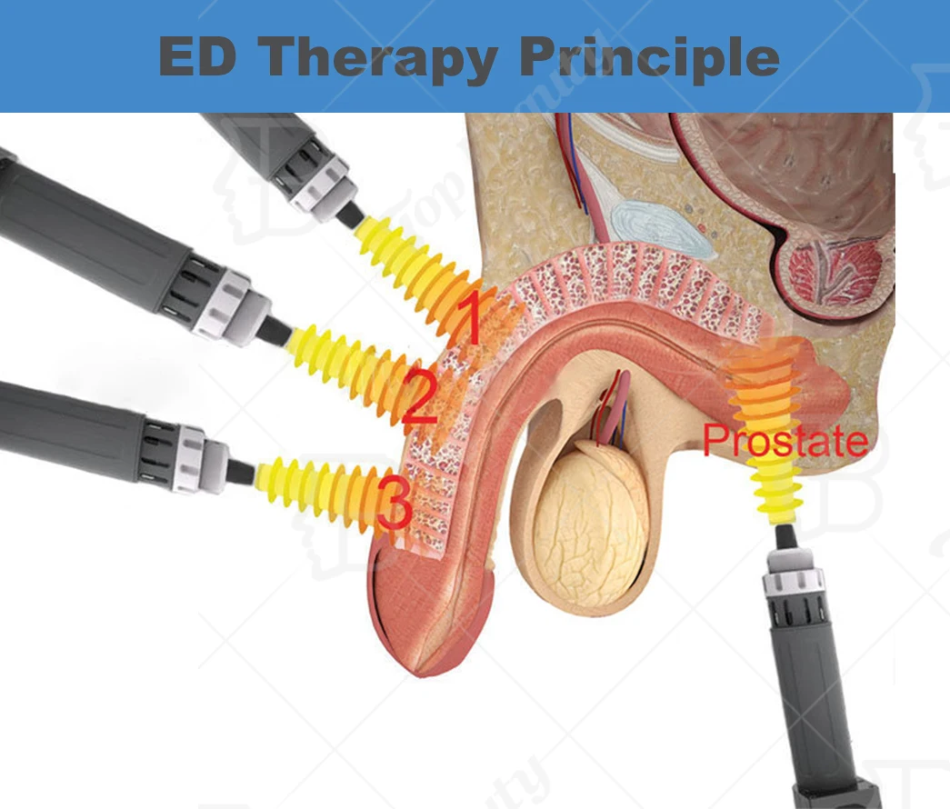 家用衝擊波機eswt為ed/衝擊波療法eswt裝置 - buy