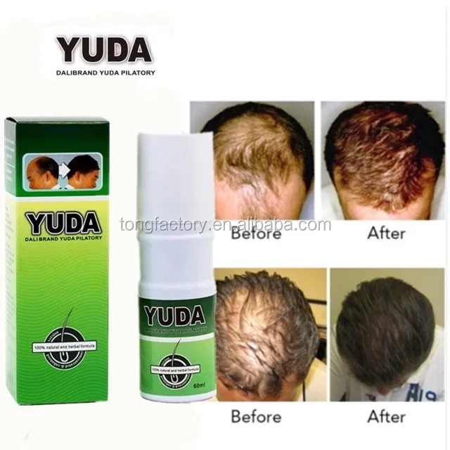 Hair Loss Treatment Yuda Organic Anti Hair Loss Bald Treatment Hair Growth Serum View Hair Growth Serum Omy Lady Product Details From Yunnan Balala