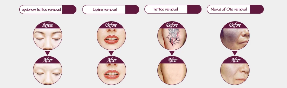 CE Approved Tattoo Removal Lasers Machine