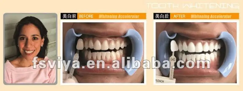 Laser Teeth Teeth Whitening Machine Price Buy Laser Teeth Whitening Machine Laser Teeth Whitening Price Laser Dental Teeth Whitening Product On Alibaba Com