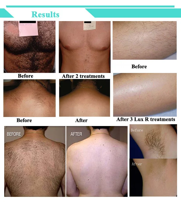 laser hair removal reviews