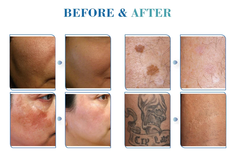 1064nm 532nm Q-switch Picosure Nd Yag Laser For Tattoo Removal