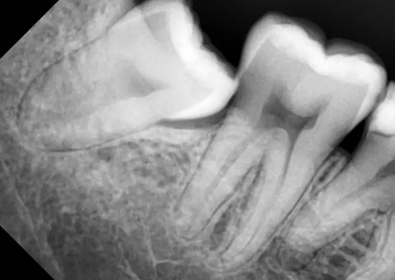 Portable Dental Xray Unit PROX /Korea Original Made Dental Xray