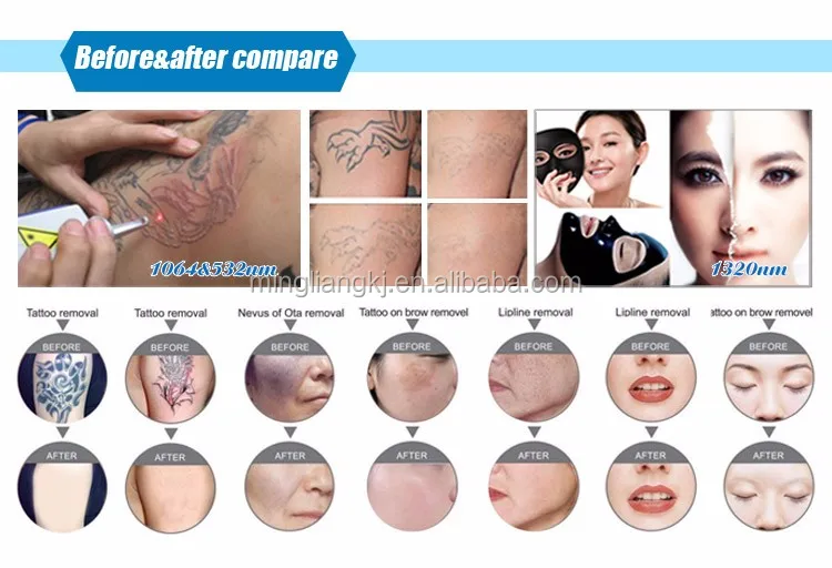 mini home use q switch nd yag laser tattoo removal machine amazon mini home use q switch nd yag laser tattoo removal machine amazon