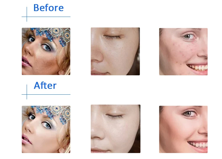 Hydrofacials Oxygen And Water Jet Peel Skin Hydropeels Tips Hydrapeel