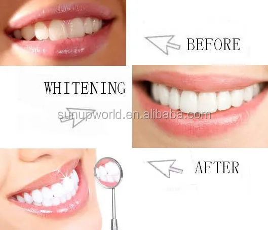Bright Smile Teeth Whitening Home Kit Tooth Bleaching Kits ...