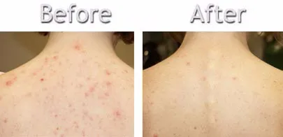 back acne removal cream