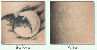 tattoo removal3