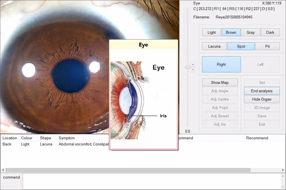 2017 New 12mp Digital Iris Analysis System Eye Iriscope Iridology
