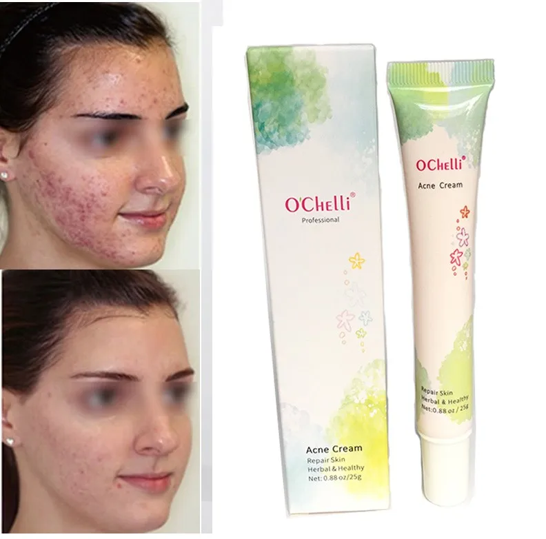 famous pimple cream