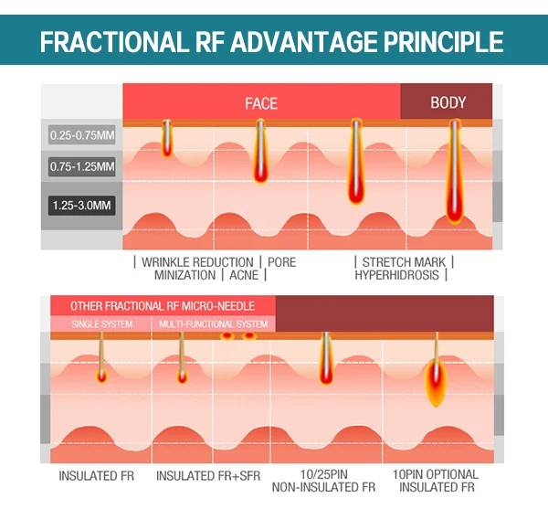 Fractional Microneedle RF SRF+MRF machine for Wrinkle Removal