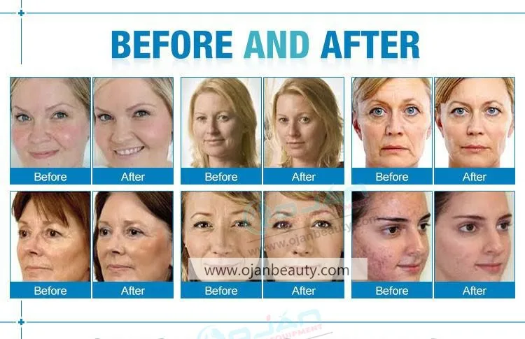 SPA 3.0 water dermabrasion  (13)