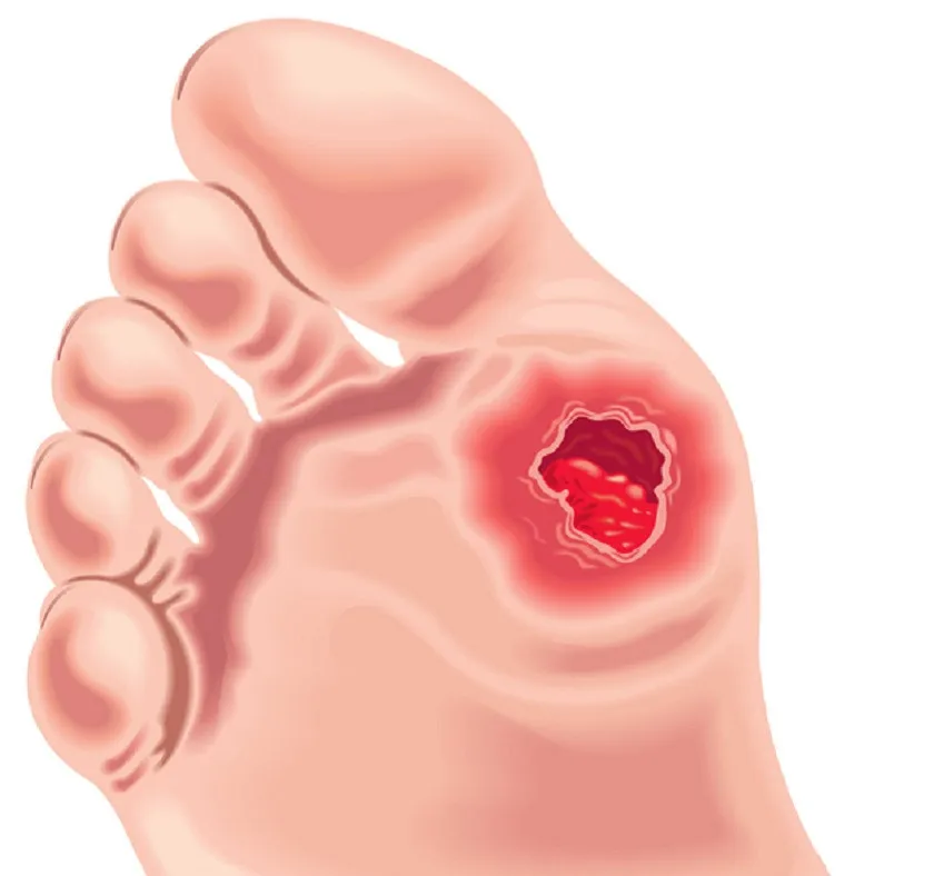 Effictive Treatment Diabetic Foot Ulcers Extracorporeal Shockwave