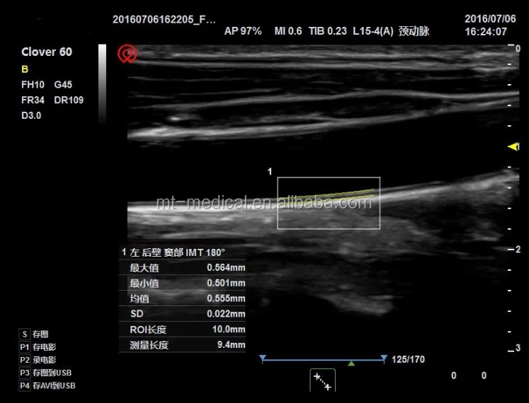 Medical Ultrasound More Than Two Probe Socket Portable Scanner