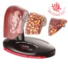 Fatty liver patient education supplies liver pathology model