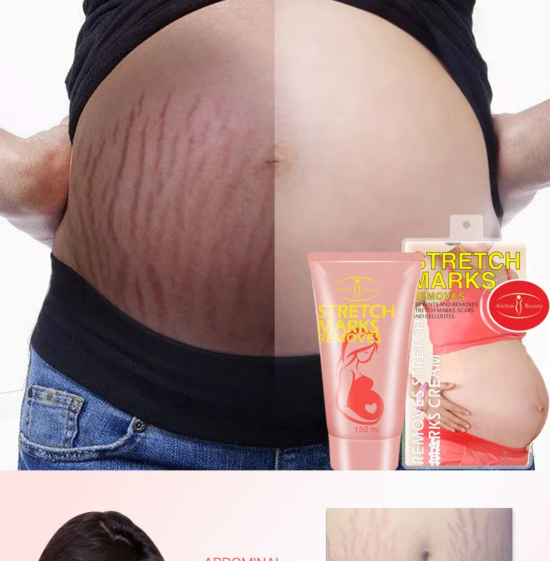 Source Aichun Beauty Strong Effective Anti Stretch Marks Cre