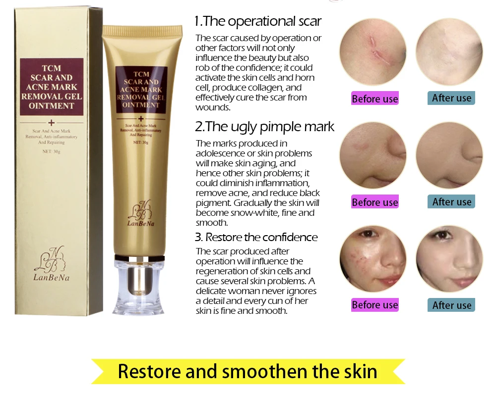 lanbena acne scar removal cream