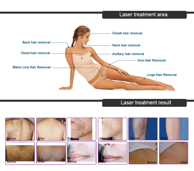 FDA approved Alma Soprano Ice Platinum laser 755 808 1064nm / diode laser hair removal machine with Soprano XL ice