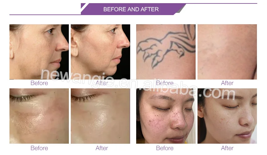 picosecond laser (7).jpg