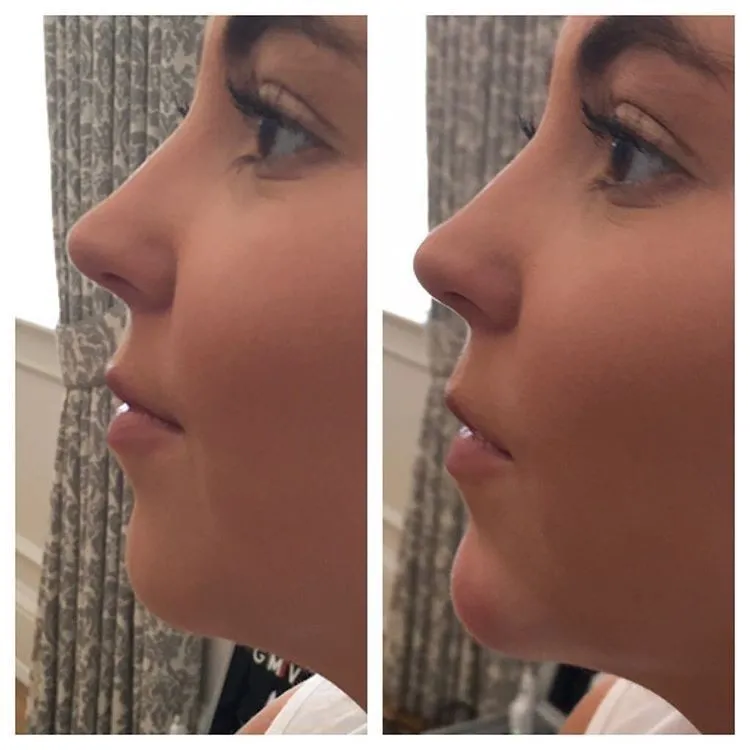 Fill plus deep филлер для губ. Dr fill отзывы губы. Dr fill ultra филлер. Dr fill plus ultra филлер. Доктор филл филлер для губ.