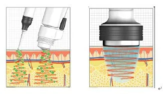 Portable electroporation no needle mesotherapy beauty equipment Electroporation Mesotherapy No Needle Machines For Salon Use - Buy