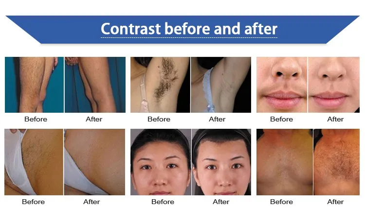 Permanent no pain hair removal 808nm diode laser hair removal machine