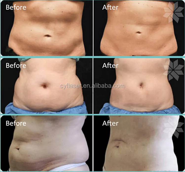 weight loss macine fat freezing machine.-.jpg