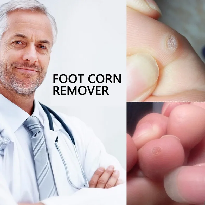 Chinese Salicylic Acid Foot Corn Remover Foot Healthcare Products