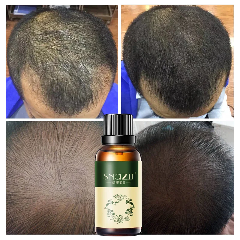 China Supplier Snazii 30ml Pure Hair Essence Serum Hair Growth Oil