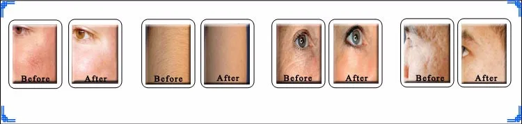 Portable Shr Ipl Laser,Ipl Photorejuvenation,Professional Ipl