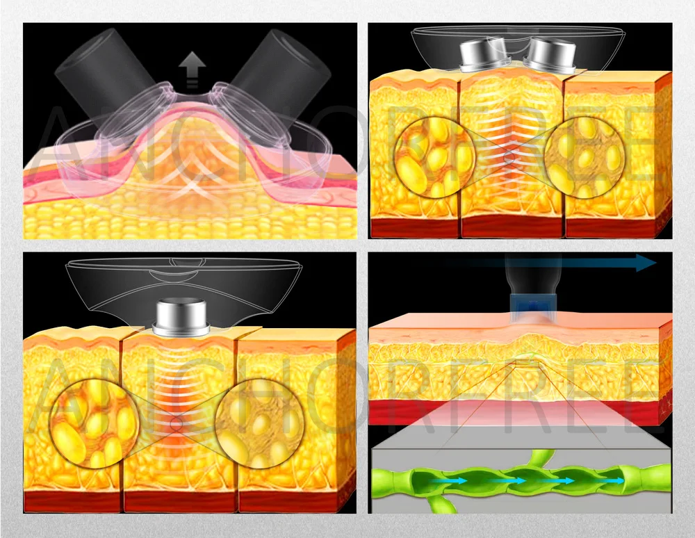 Кавитация жиров. Кавитация жиров. Ультразвуковая кавитация схема. Ультразвуковая кавитация принцип действия. Кавитация ультразвуковая липосакция.