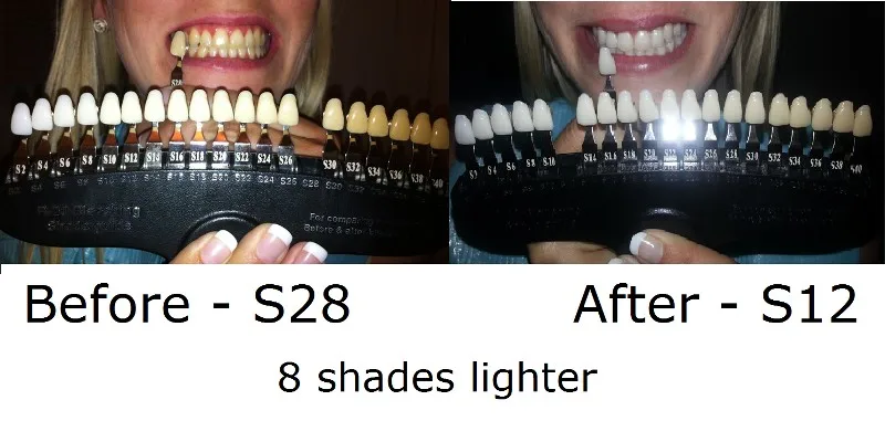 Tooth Whitening/teeth Bleaching Shade Guide,For Dental And ...