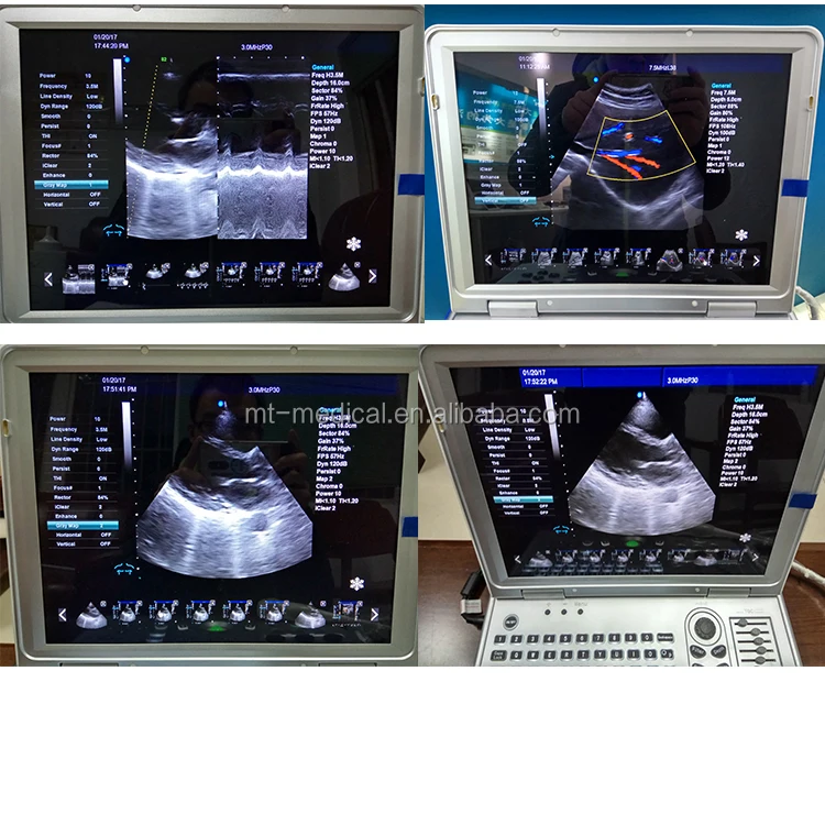 Cardiac Portable Ultrasound Machine 4D