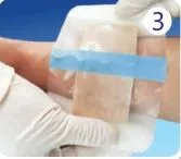 Medical consumables 5*15 cm Advanced Hydrocolloid wound patch with thin border