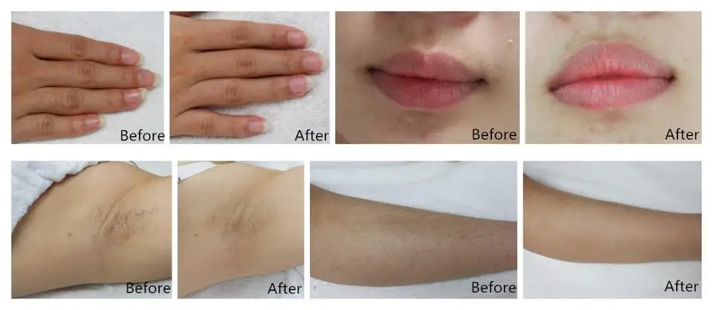 DEESS 2018 new product IPL laser permanent hair removal at home with 300000shots lamp life