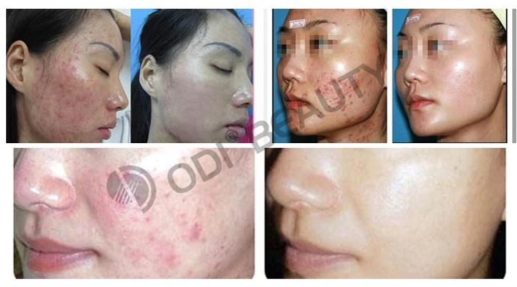 Hot! 250mw intensity skin rejuvenation water oxygen jet peel machine