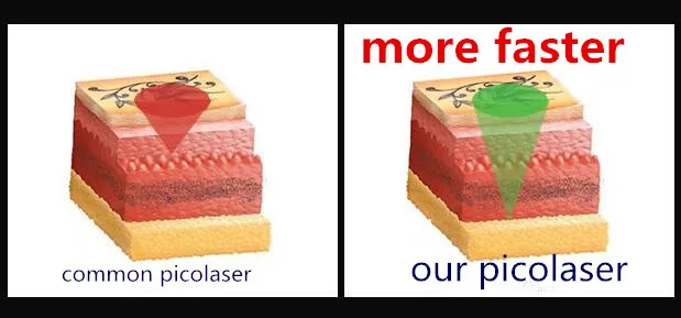 Hot Sale Portable 1064nm 532nm Picosecond Laser For Tattoo Removal Pigmentation