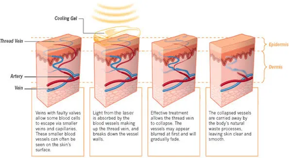 class 4 laser treatment