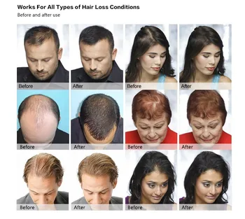Professional Care Protein Hair Treatment Product Stop Hair Loss