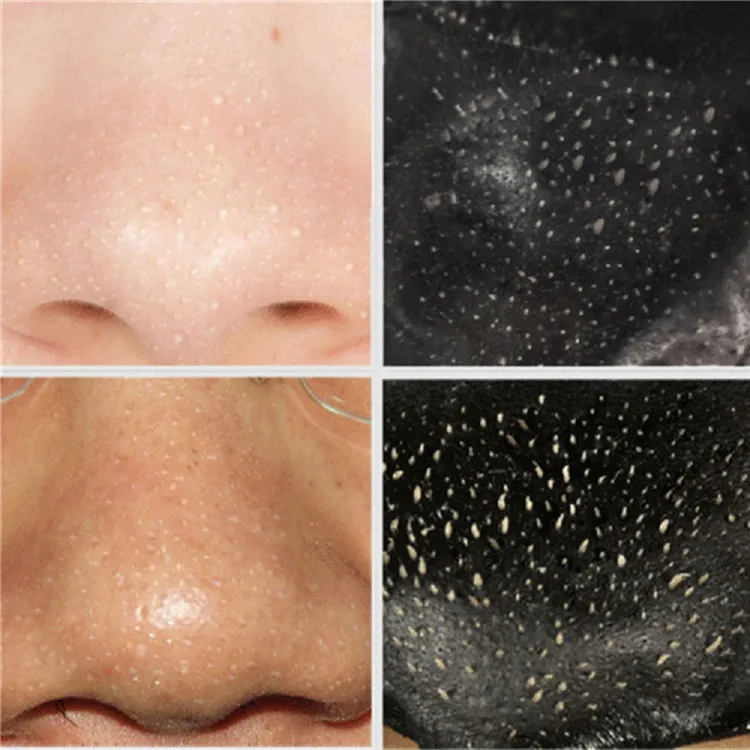 Как правильно снимать маску от черных точек Top Rated Pore Blackhead Deep Cleansing Remover Blackhead Removal Nose Strips - 