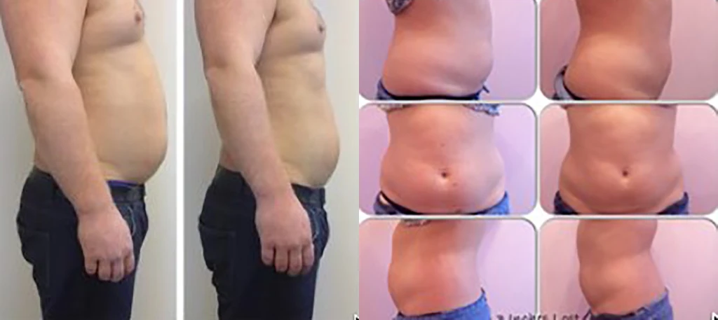 Кавитация живота отзывы до и после фото Slimming Machine Double Shape Vacuum Roller Radiofrequencia Liposuction Ultra Ca